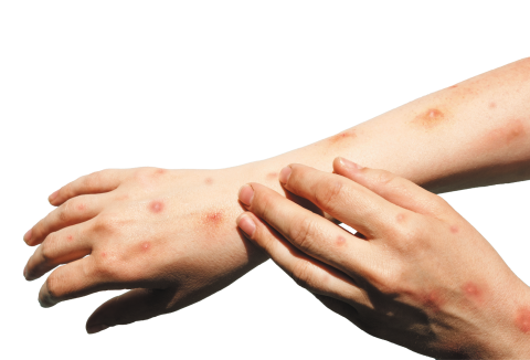 hands and arms covered in chickenpox