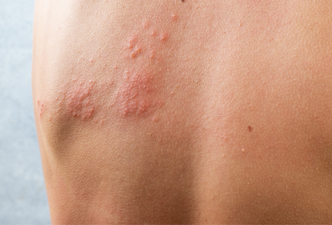 person's back covered in shingles