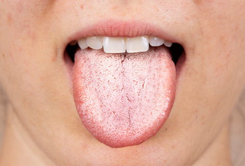 mouth showing oral thrush on tongue