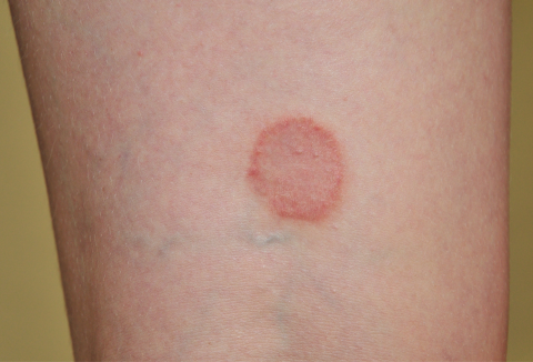 circular rash showing on skin